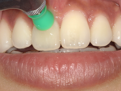 オフィスホワイトニング