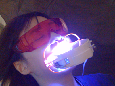 オフィスホワイトニング