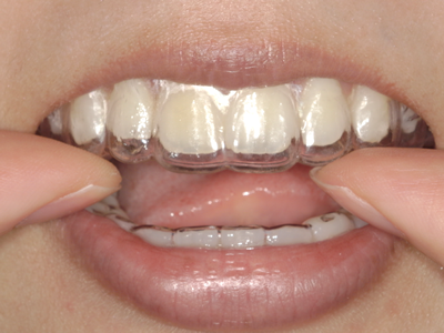 ホームホワイトニング